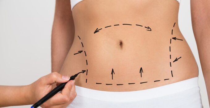 How Much Does a Tummy Tuck Cost in 2022