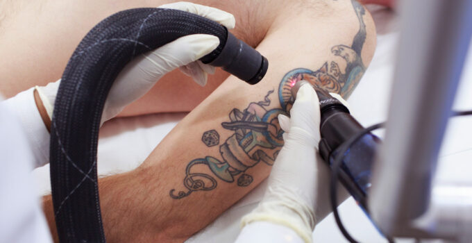 What is the Best Tattoo Removal Studio in Melbourne, AU